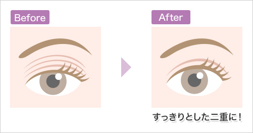 すっきりした二重まぶたに!